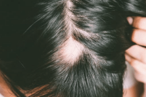 foto de cabeza con calva por caída del pelo por estress